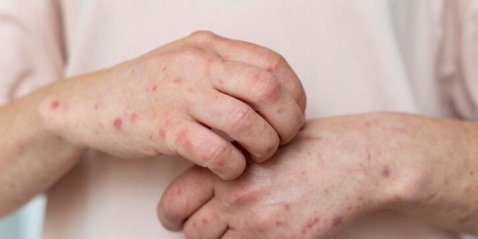 Surto de sarna humana em Minas? Governo monitora casos da doença em cidade do Centro-Oeste