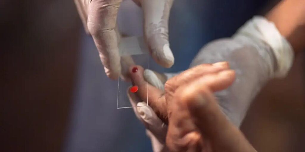 SUS começa a usar novo tratamento contra a malária em crianças