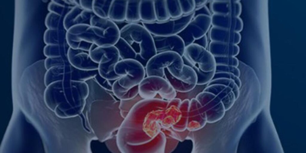 Rastreamento para câncer colorretal pode ser implementado no SUS