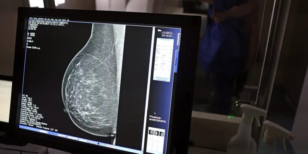 Plano de saúde terá que cobrir mamografia digital para todas as idades